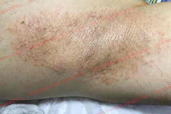 Процедура после, м. Фрунзенская Иллюстрация: после воздействия