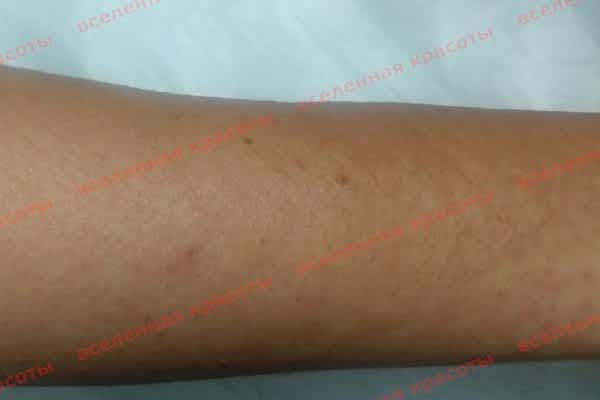 Процедура после Иллюстрация: после воздействия