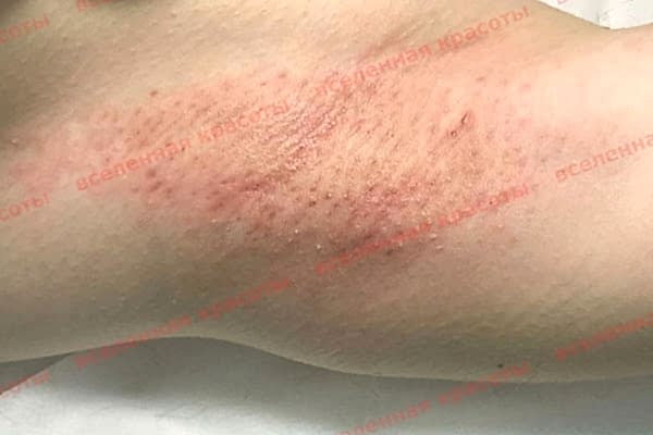 Процедура после Иллюстрация: после воздействия