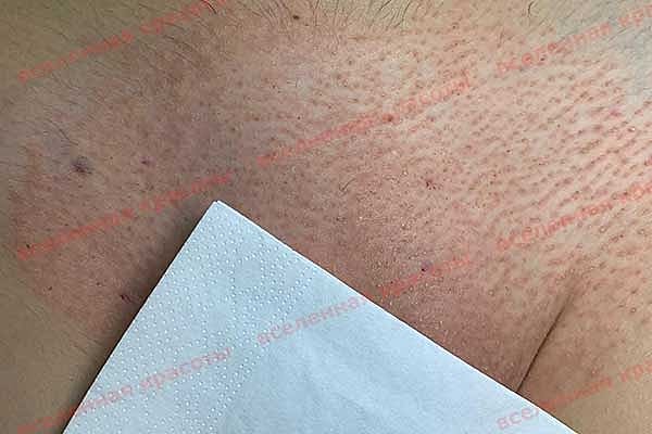 Процедура после Иллюстрация: после сеанса