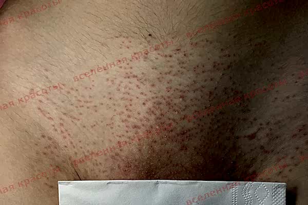 Процедура после Иллюстрация: после сеанса