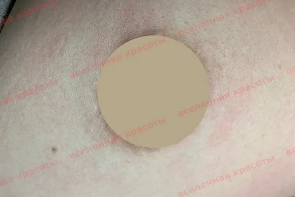 Процедура после Иллюстрация: после воздействия