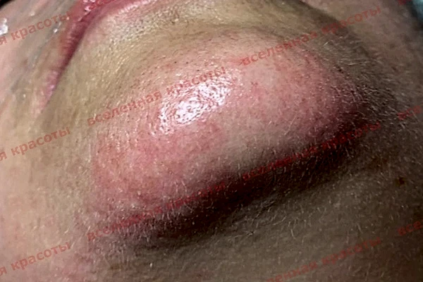 Процедура после Иллюстрация: после сеанса