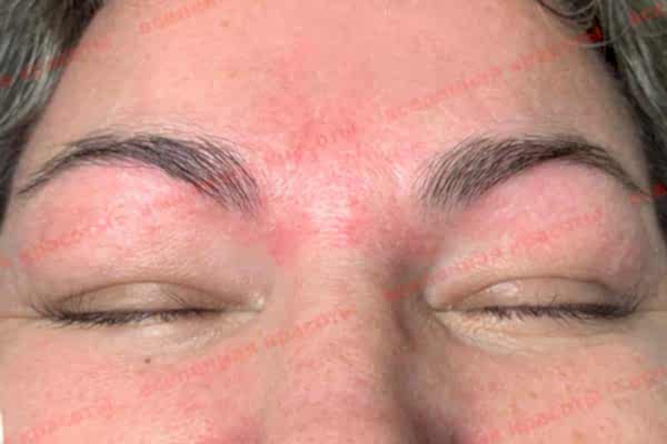 Процедура после Иллюстрация: после сеанса