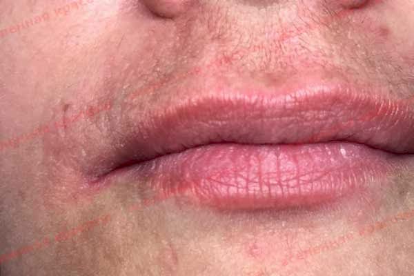 Процедура после Иллюстрация: после сеанса