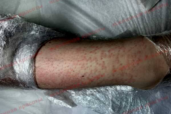 Иллюстрация: после воздействия